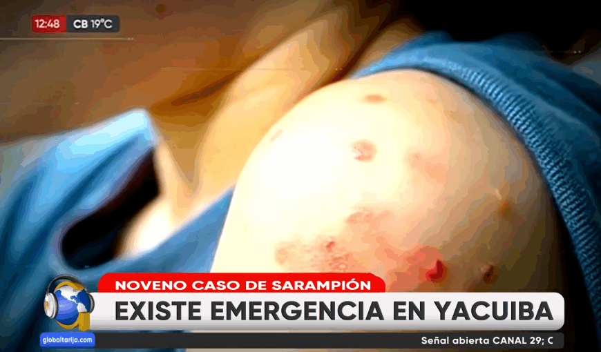 DETECTAN NOVENO CASO DE SARAMPIÓN&hellip;
